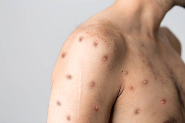 Dinkes Banyuwangi Minta Warga Waspada Terhadap Monkeypox